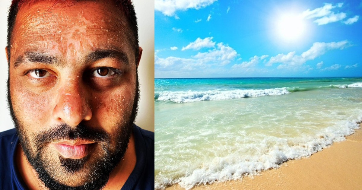 Badshah Gets Sunburnt In Maldives; Here’s How To Prevent Sunburn On A Vacation