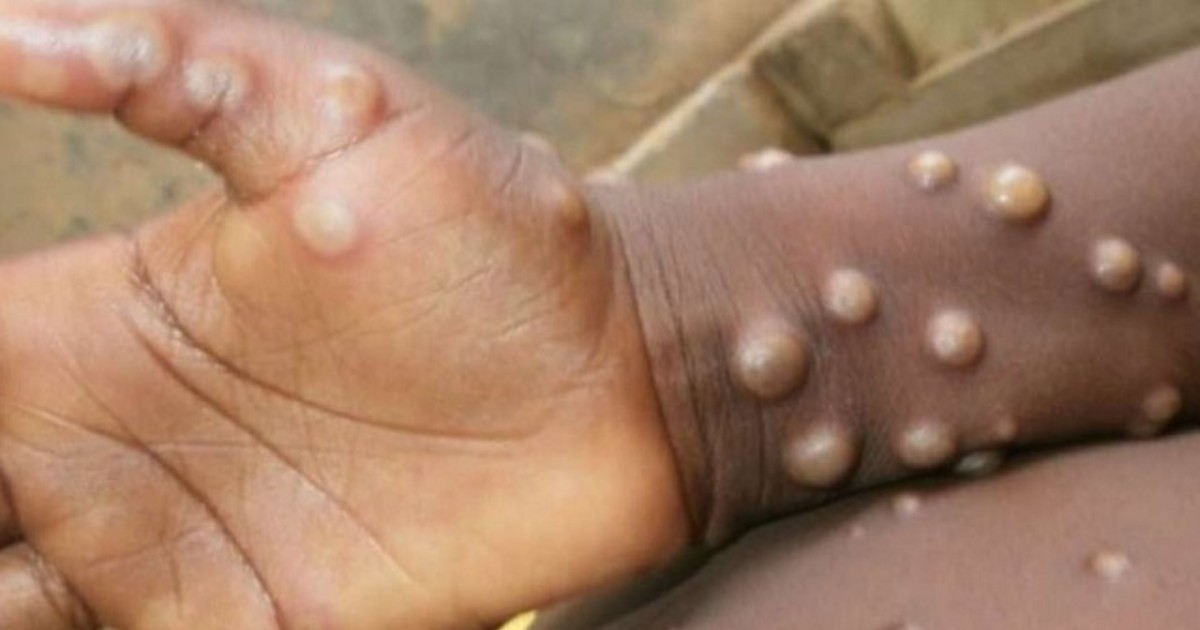 India Issues Travel Advisory For International Passengers After Confirmed Case Of Monkeypox