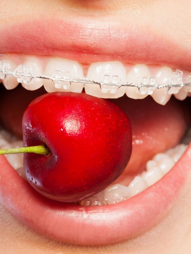 9 Food Items To Avoid After Getting Braces