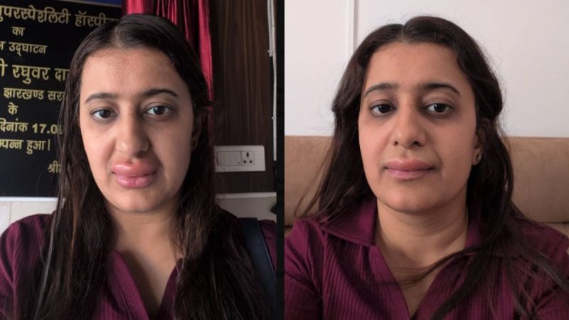 Woman Gets Allergic Reaction After Eating Meal On Vande Bharat Express; IRCTC Says…